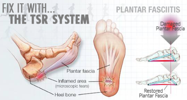 The Plantar Fasciitis Program By Got Rom