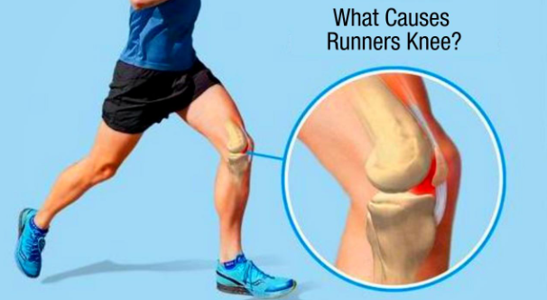 The Runners Knee Program